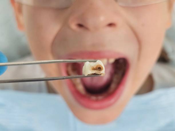 Best Emergency Tooth Extraction in Vail, CO